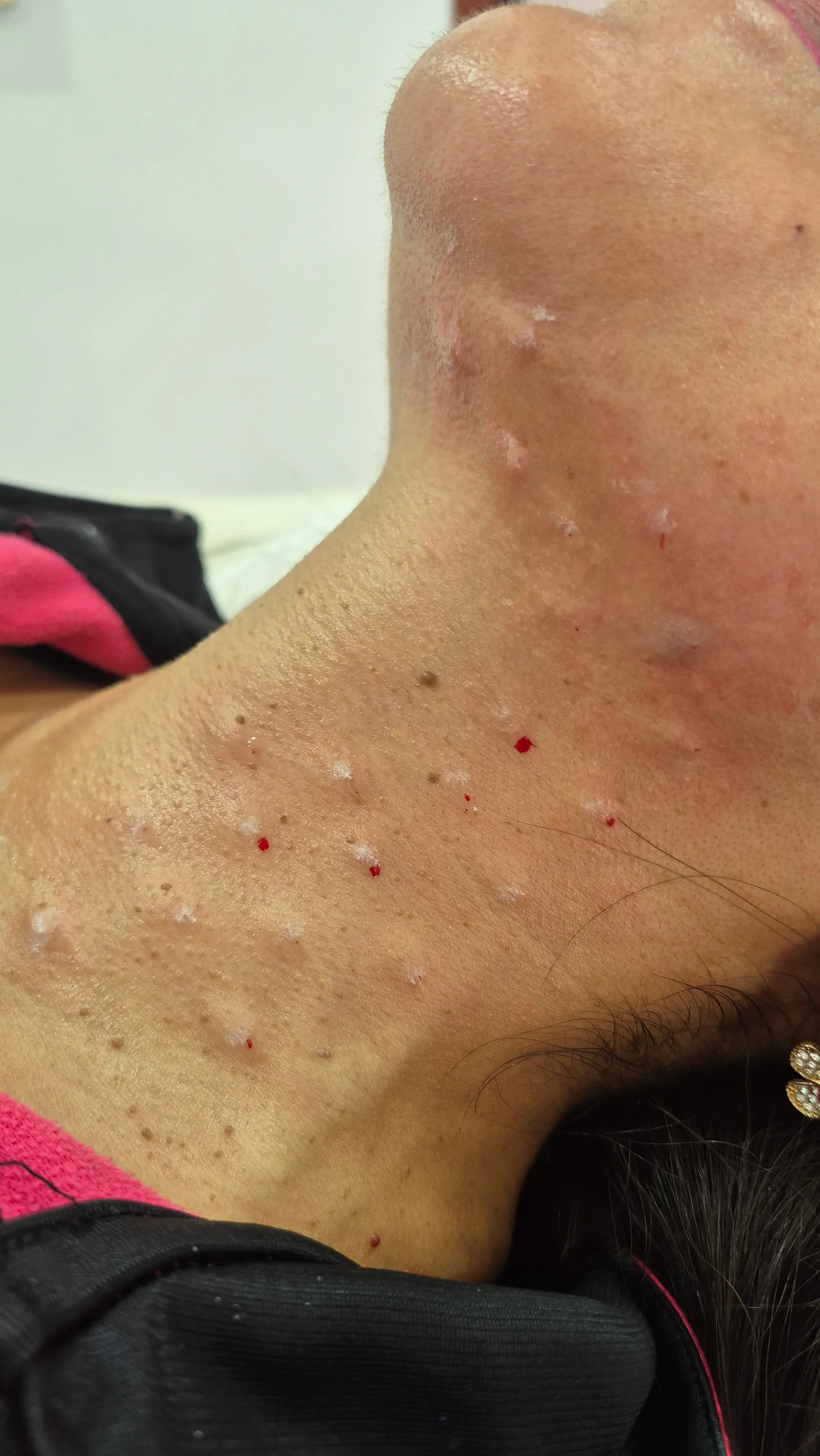 Microinyecciones de ADN de salmón en zona de cuello — CheckVital La Serena