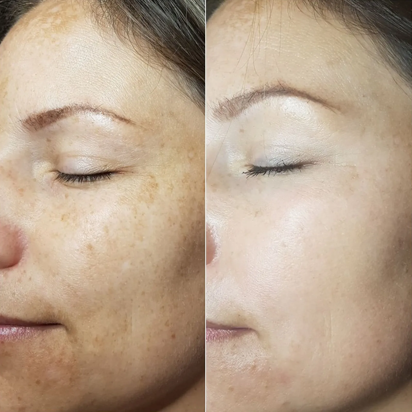 Resultado peeling La Serena CheckVital