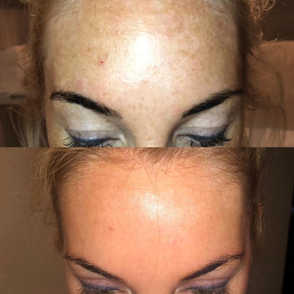 Tratamiento manchas peeling químico La Serena