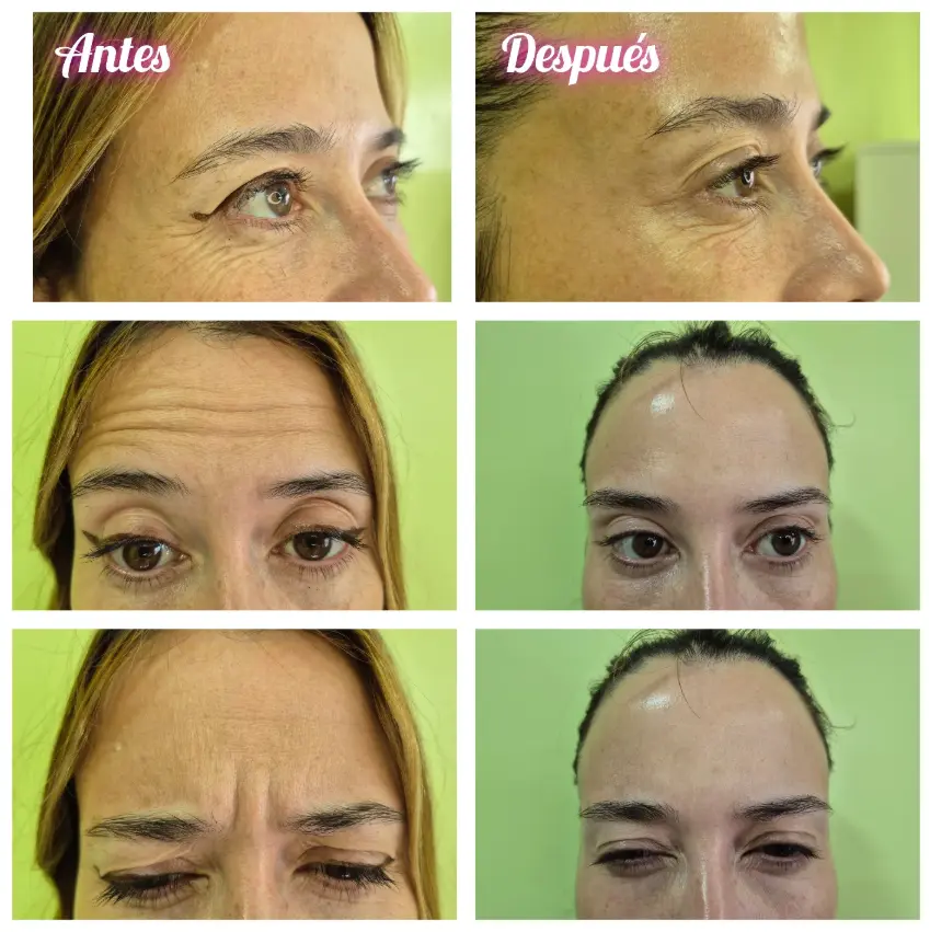 Zonas comunes de aplicación de Botox