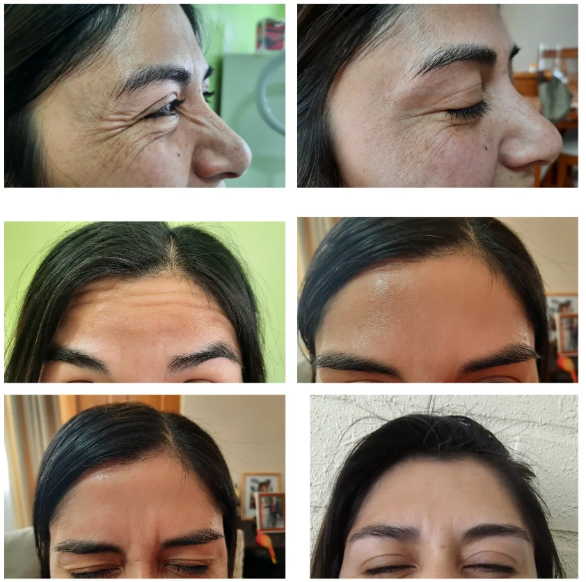 Resultado del tratamiento con Botox en rostro