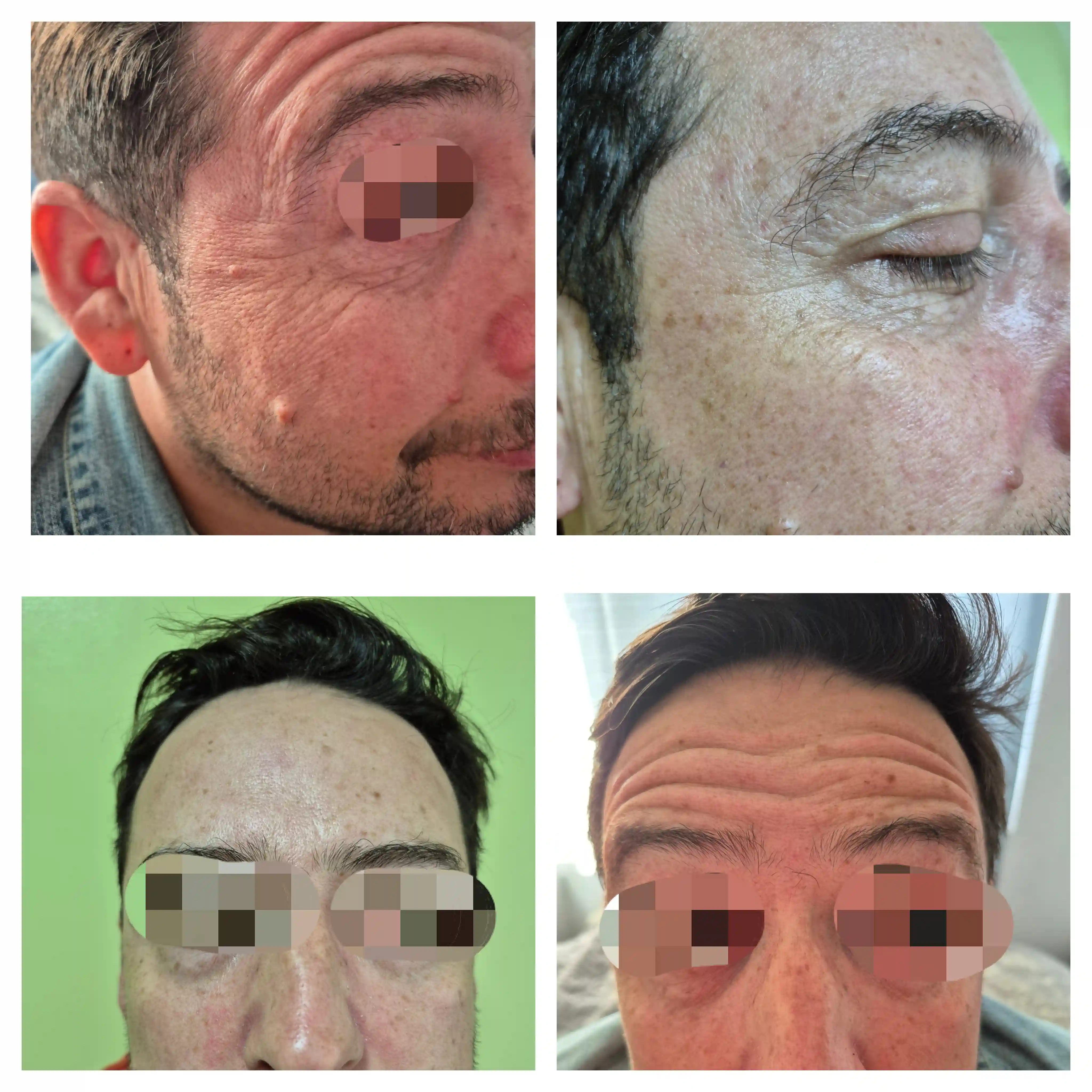 Aplicación de Botox
