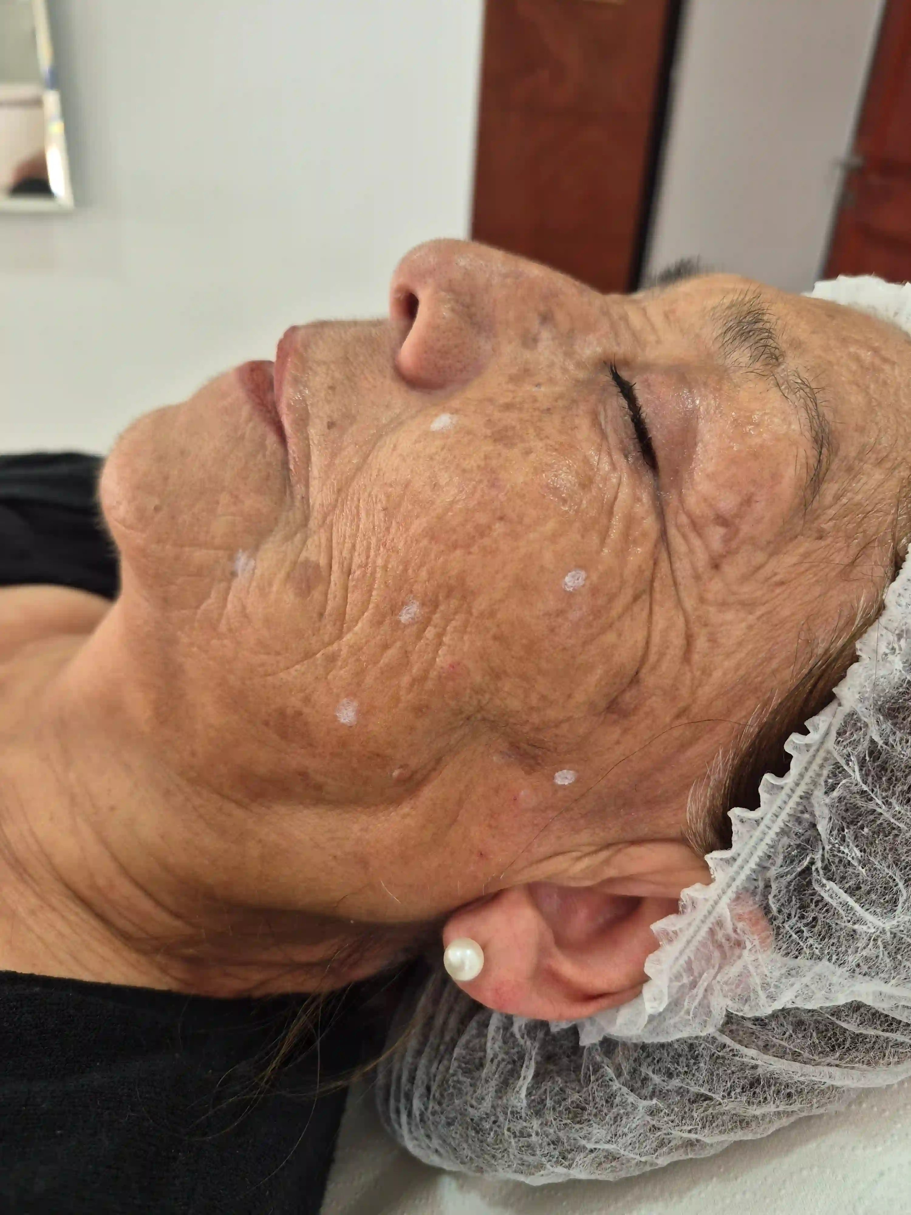 Celosome Aqua inyectable rejuvenecimiento facial La Serena