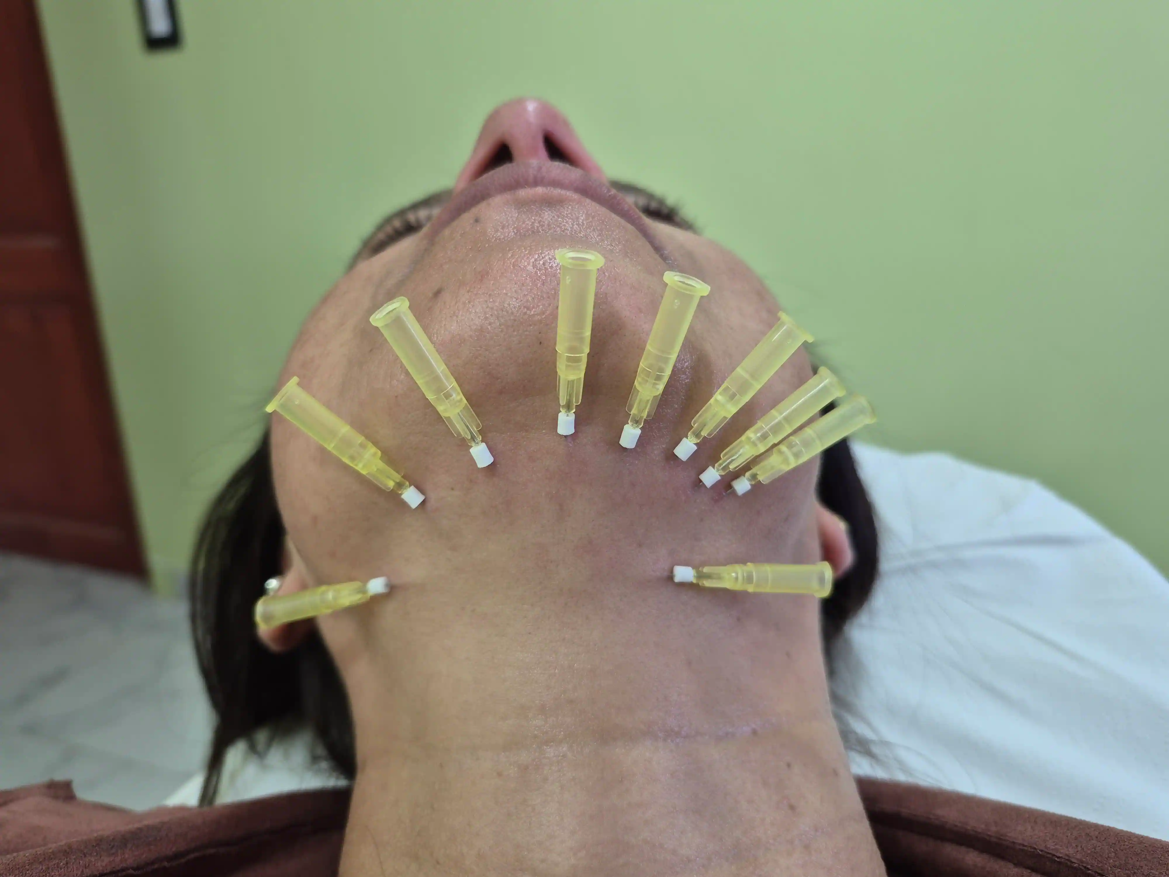 Resultados finales del tratamiento con hilos tensores