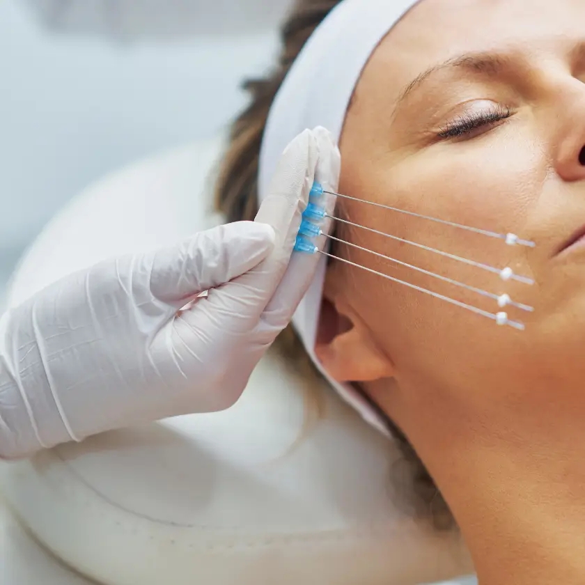 Hilos Tensores La Serena | Lifting facial sin cirugía