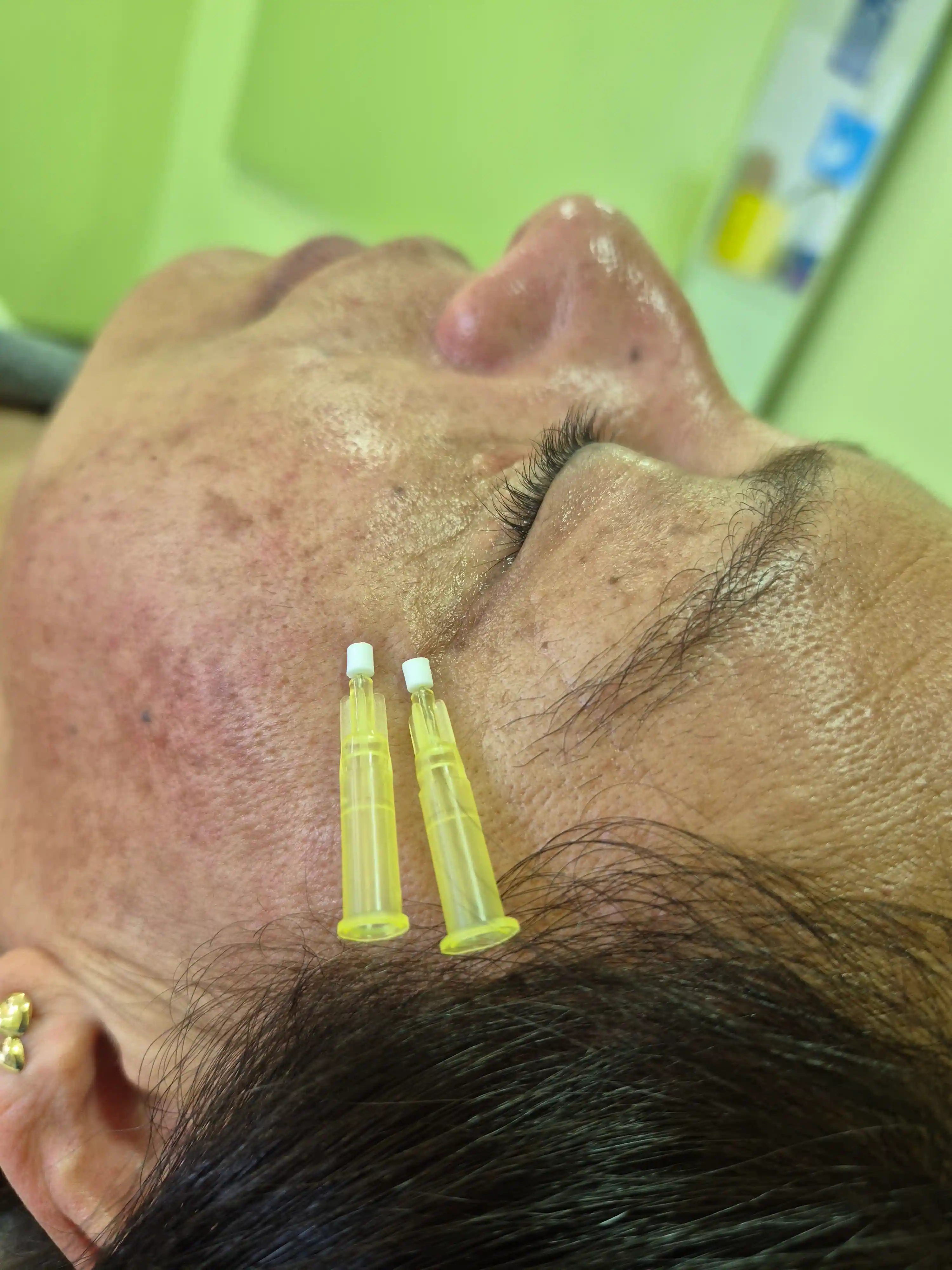 Zonas de aplicación de hilos tensores