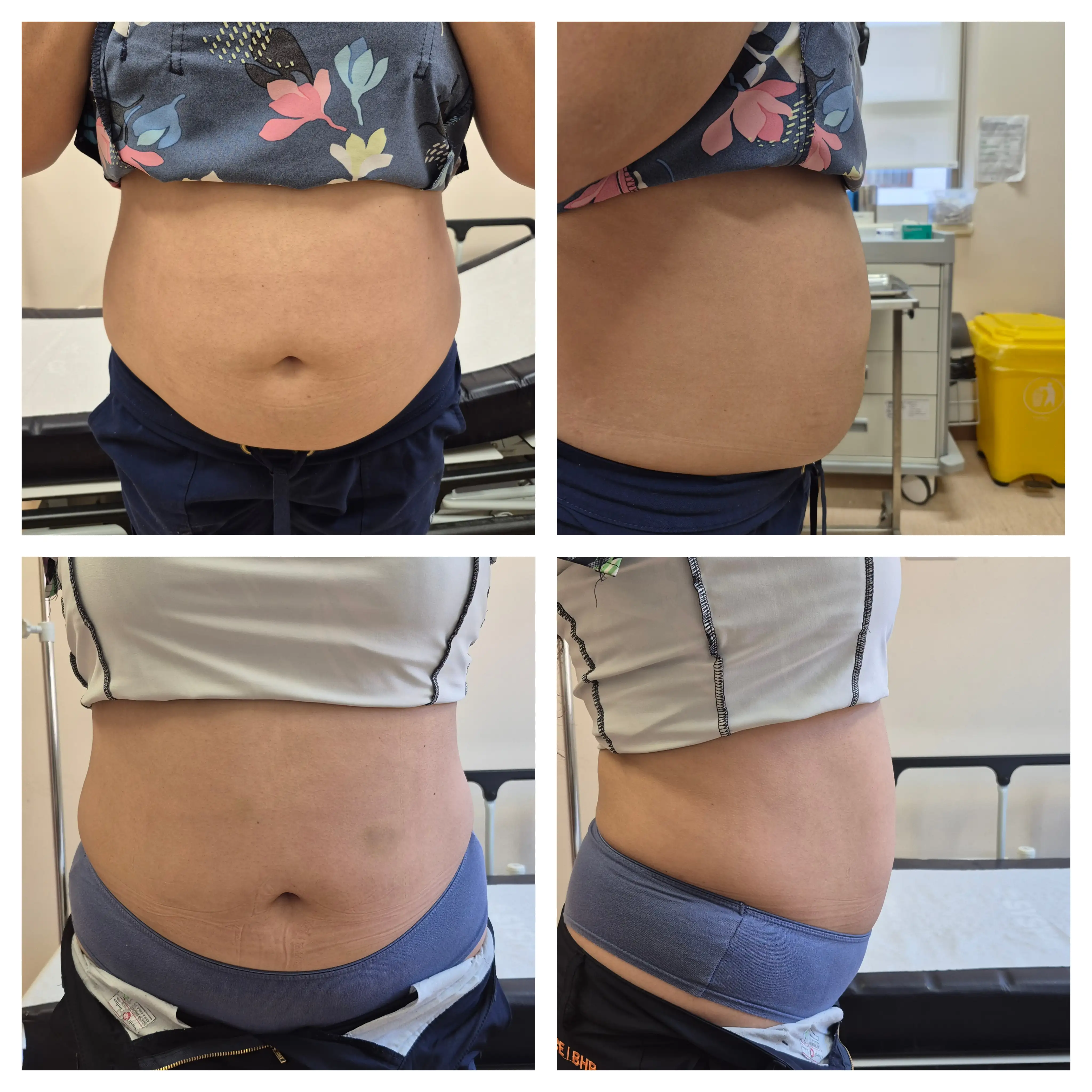 Beneficios del tratamiento Lipolax