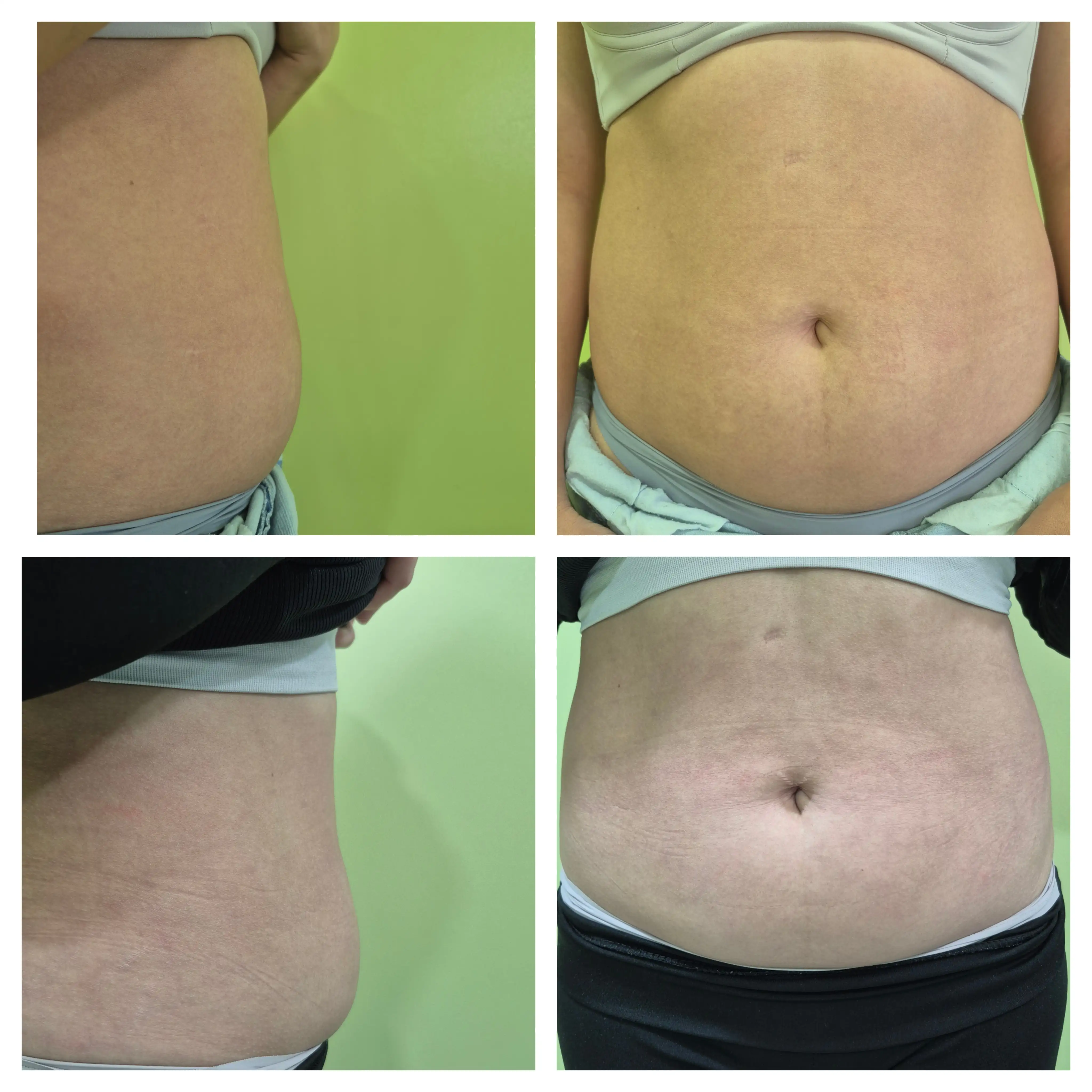 Zonas más comunes para Lipolax