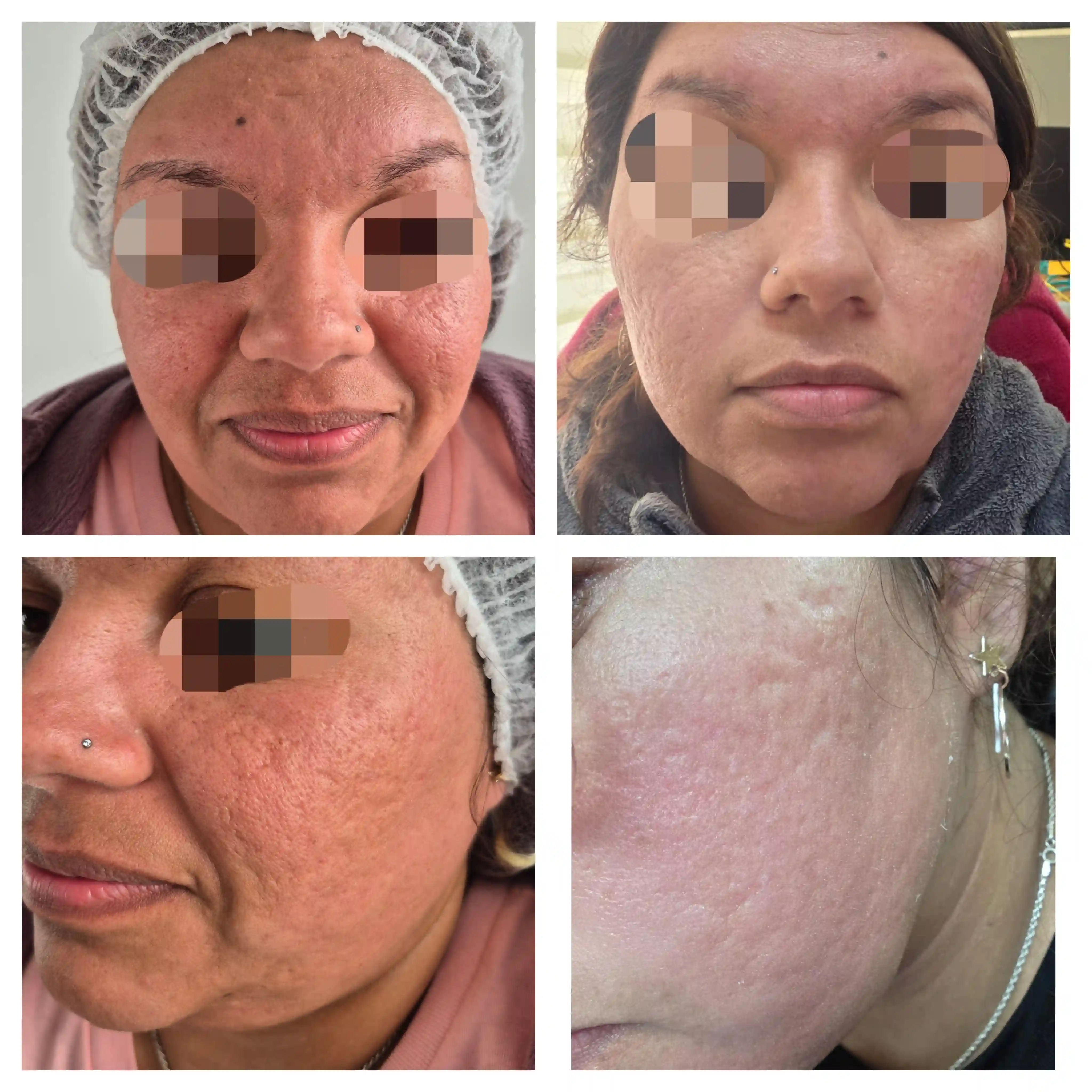 Resultado Peeling de Algas antes y después CheckVital La Serena