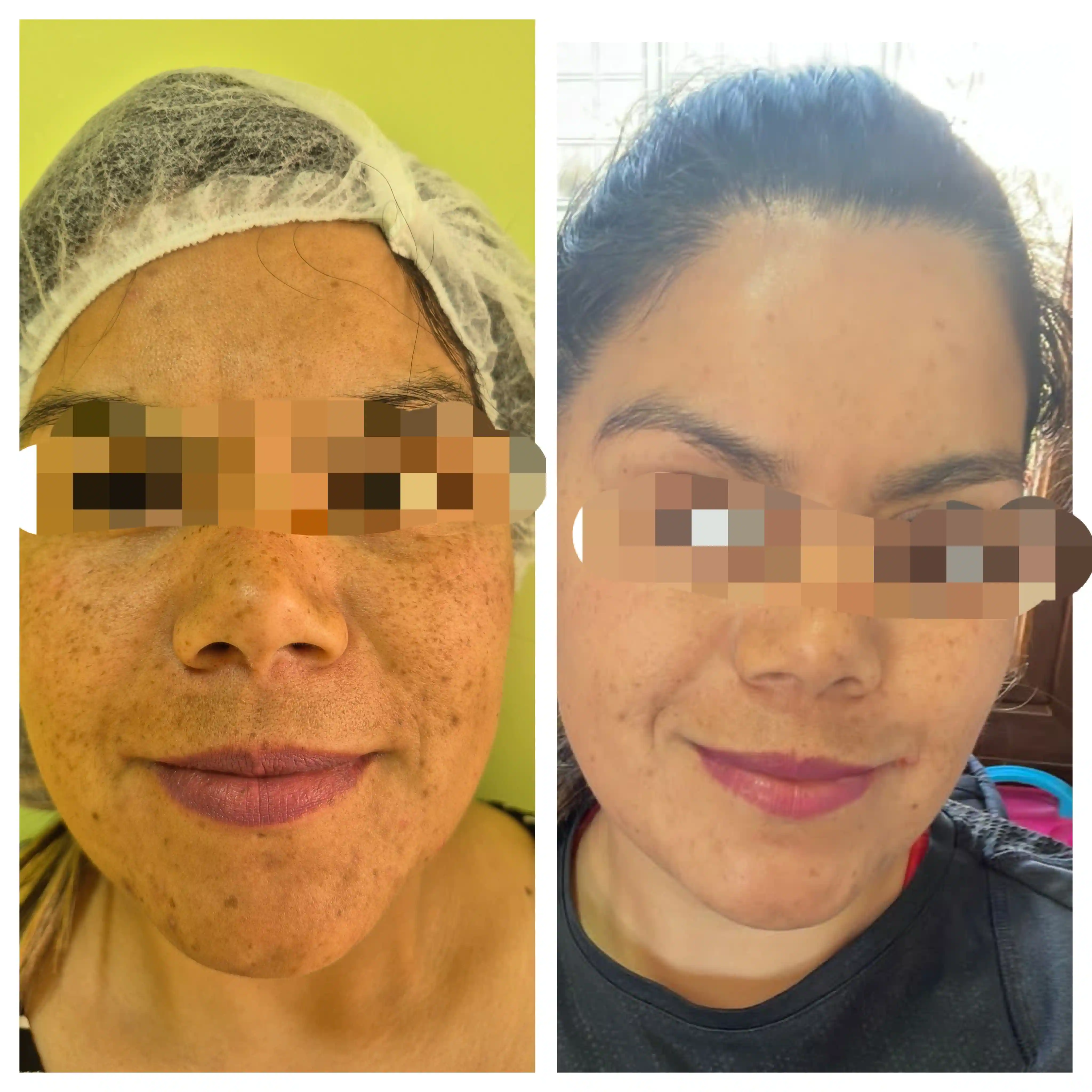 Antes y después Peeling de Algas La Serena CheckVital
