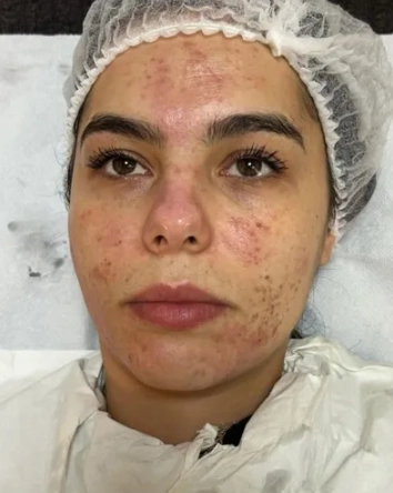 Resultado Peeling 1