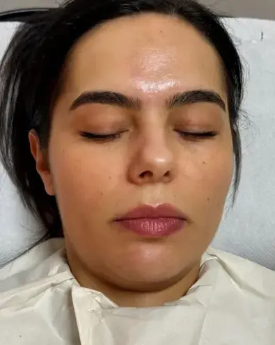 Resultado Peeling 2