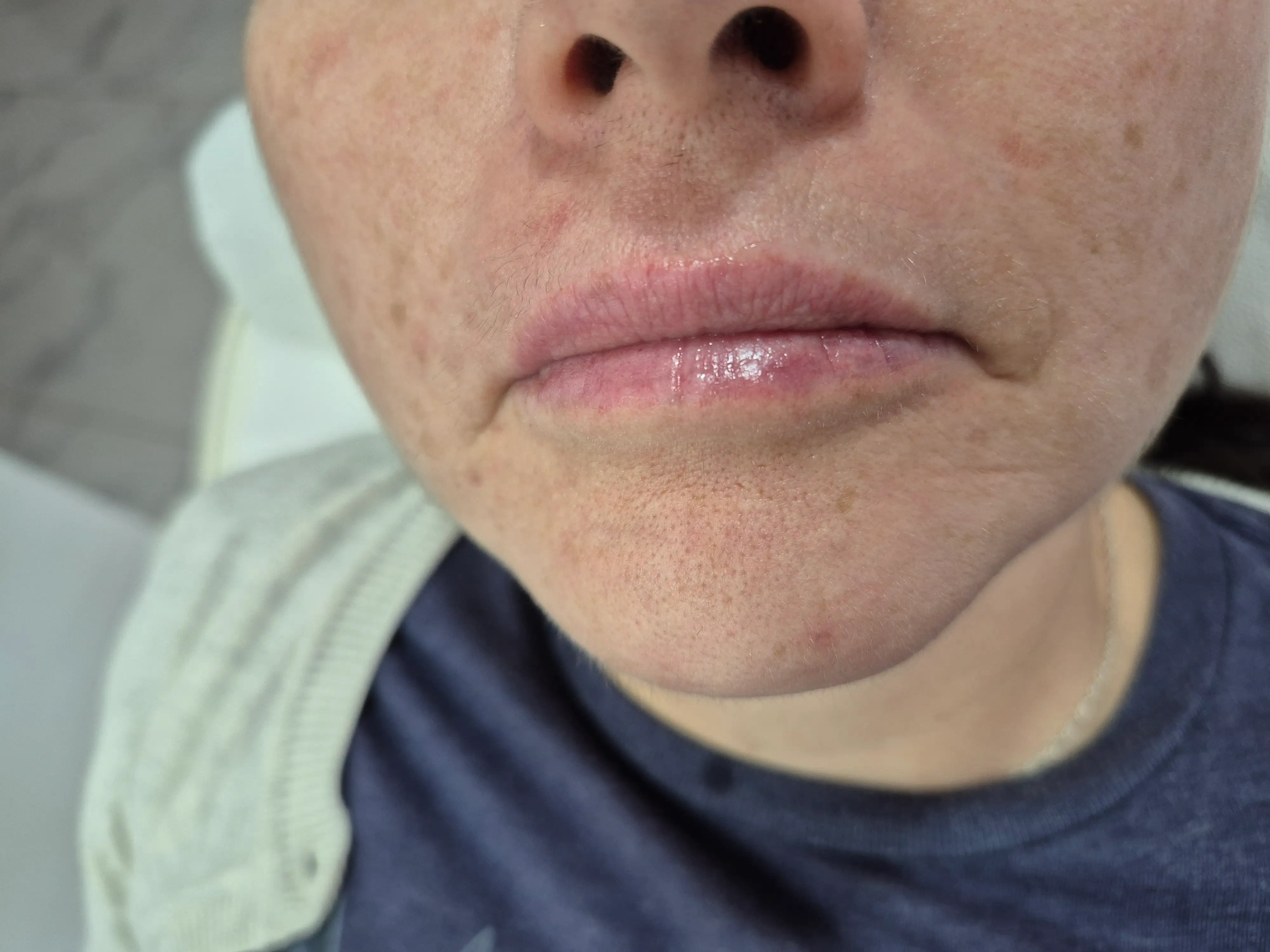 Antes y después Perfect Lips labios CheckVital La Serena