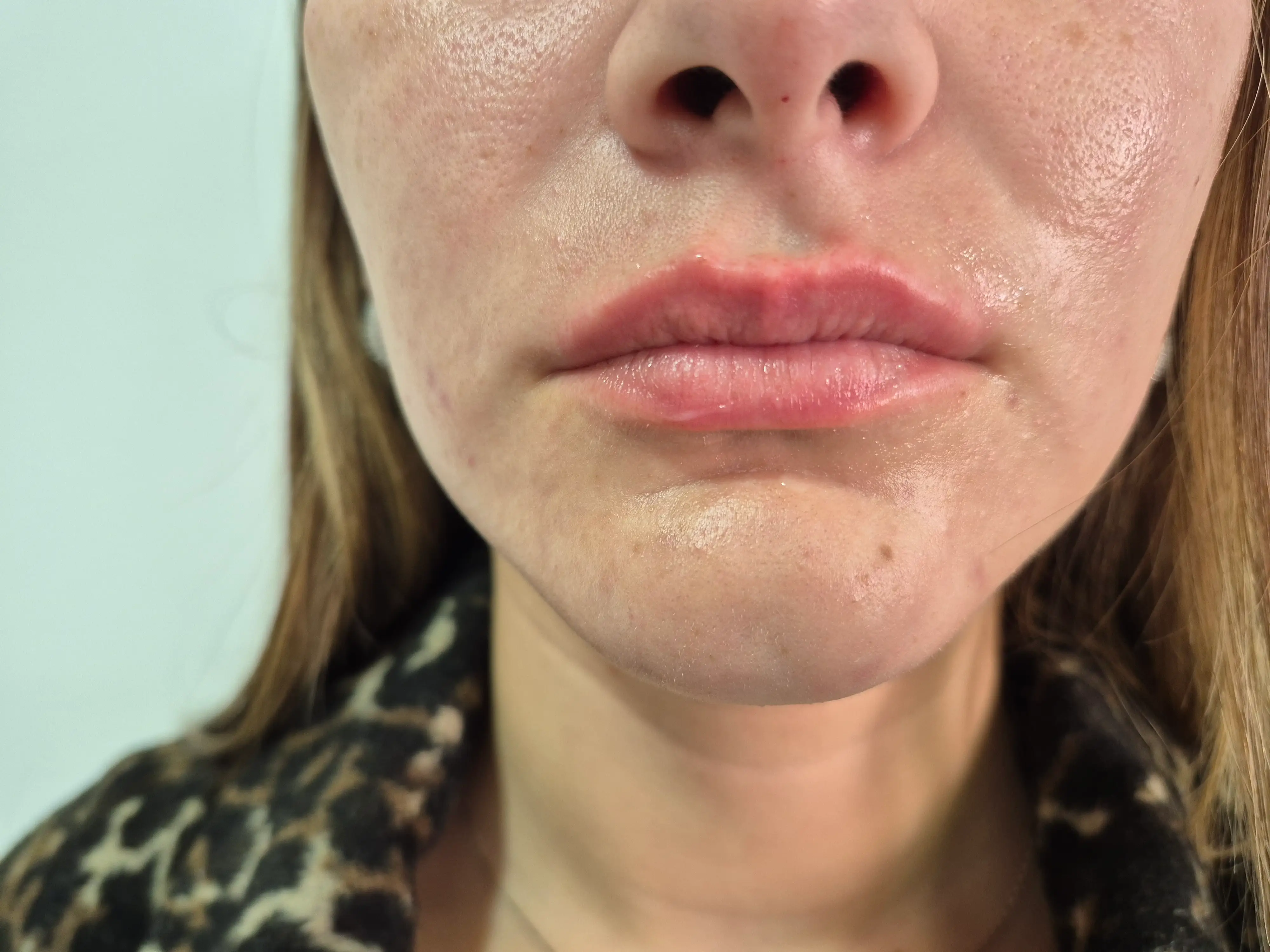 Resultado Perfect Lips hidratación labios La Serena