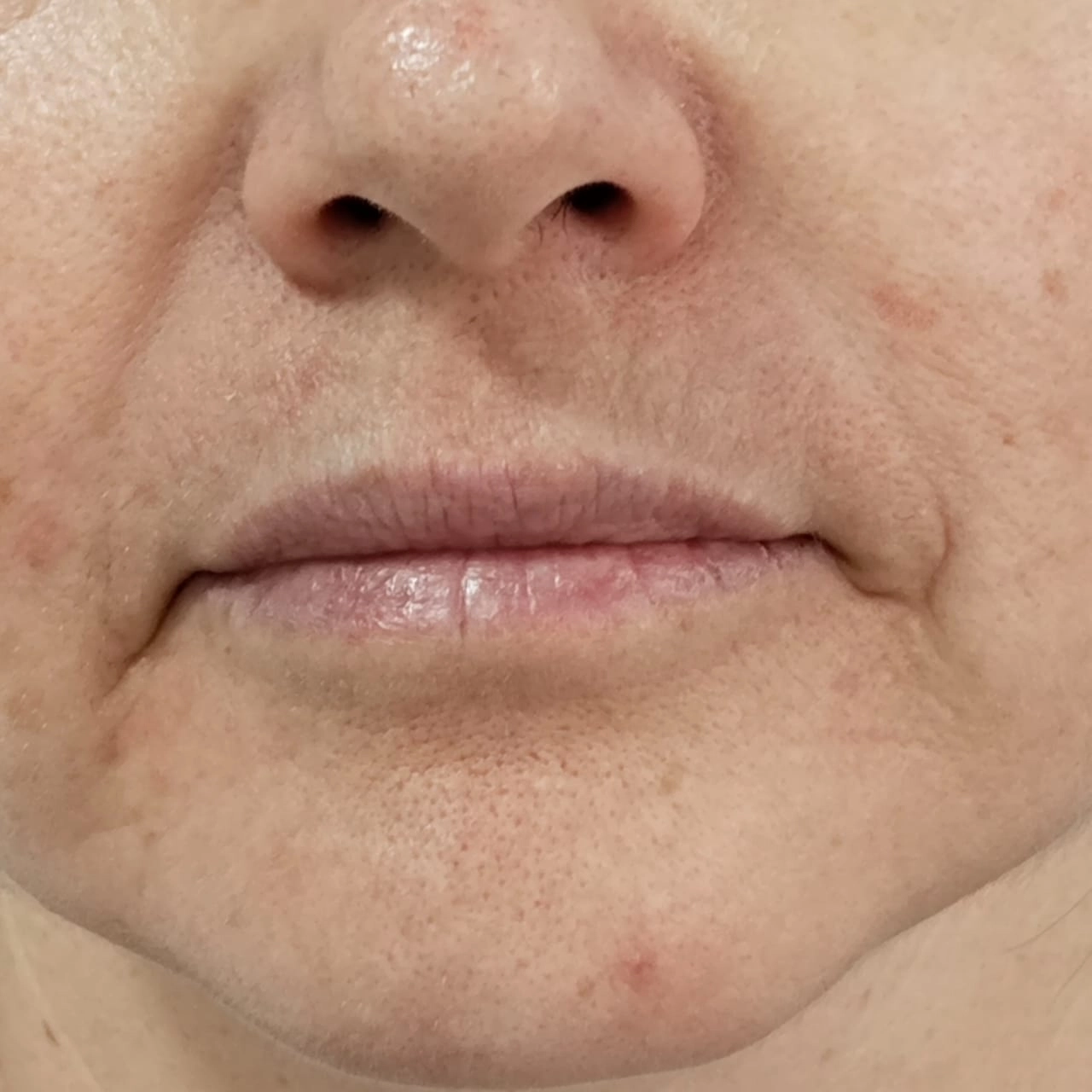 Perfect Lips antes y después CheckVital
