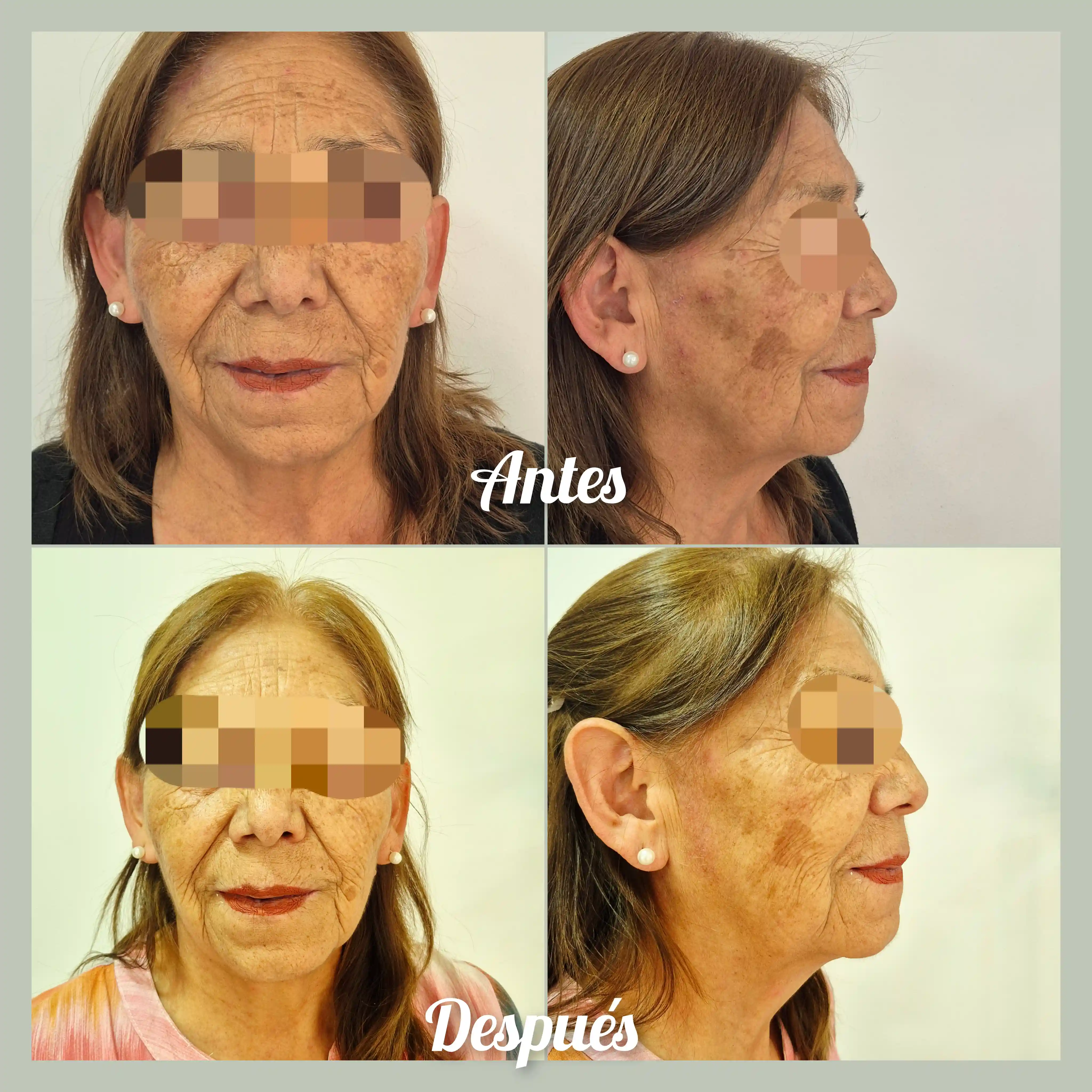Resultado Skinbooster Celosome Aqua antes y después CheckVital La Serena